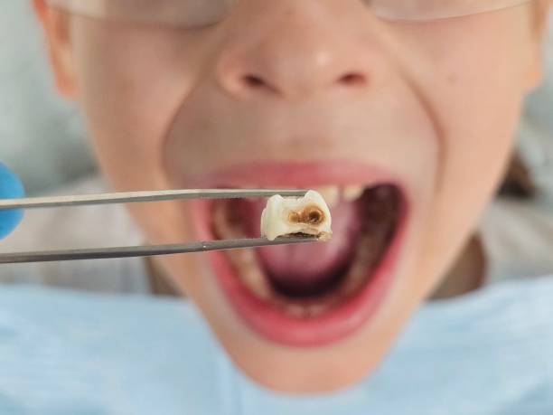 Best Emergency Dental Care for Sports Injuries in South Pittsburg, TN